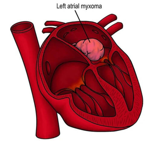 Cardiac Tumour