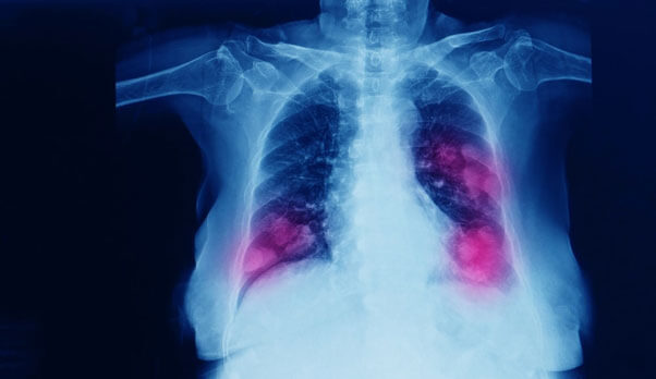 Lung Surgery