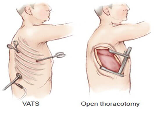 Types of Lung Surgery