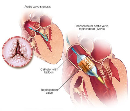 TAVI / TAVR & MitraClip